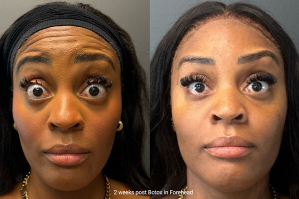 ba-botox-26-1 ba-botox-26-1