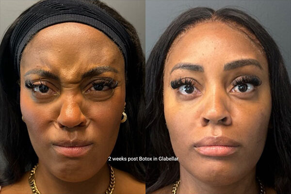 ba-botox-26-2.jpg ba-botox-26-2.jpg