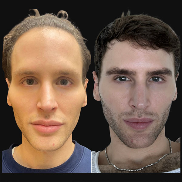 Sculptra-Tighten-Brighte