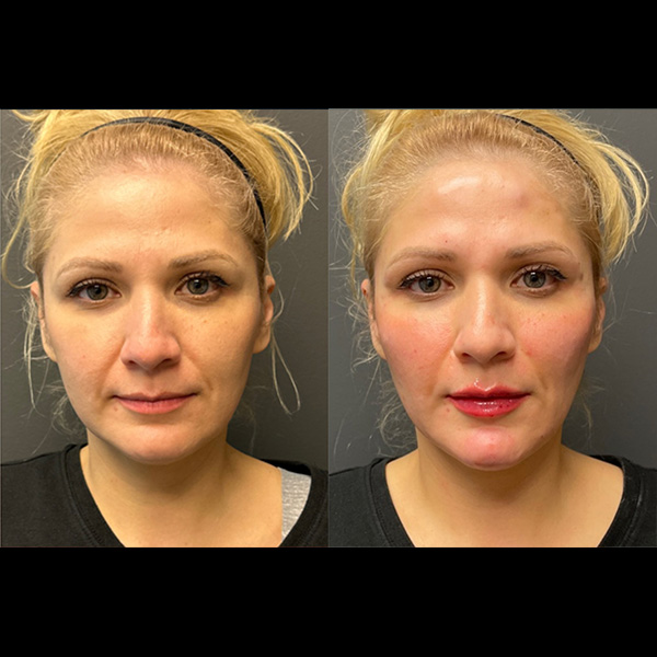 Voluma-Immediate-post-treatment-Cheeks-Chin-and-Lips