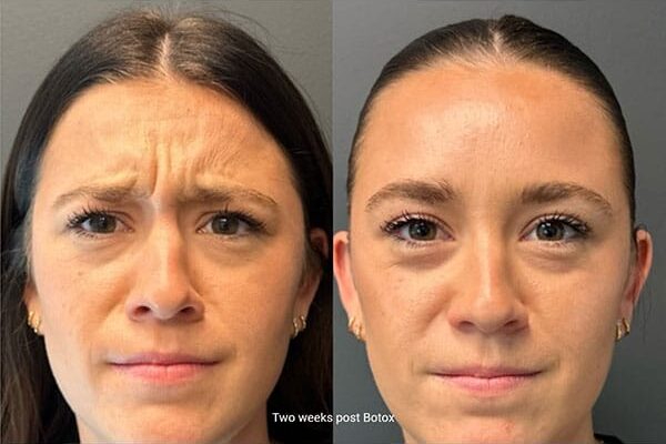 ba-botox-27-1 ba-botox-27-1