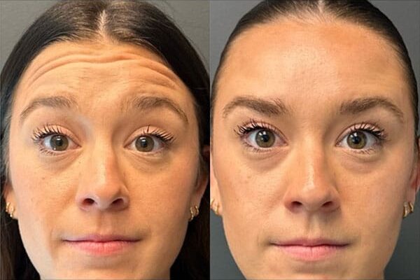 ba-botox-27-2 ba-botox-27-2