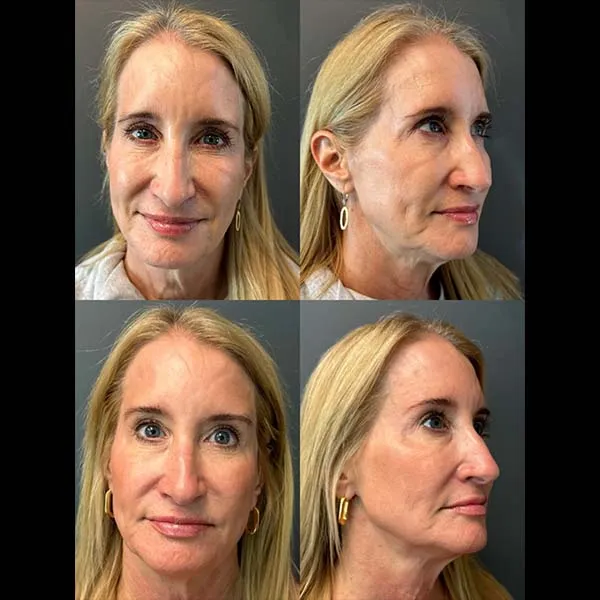 1-voluma-1-vollure-2-rounds-of-skinvive