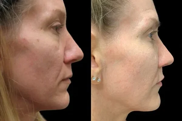 3d-facelift-sculptra 3d-facelift-sculptra