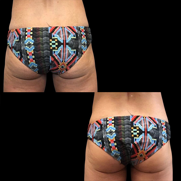 Accufit-x4-Treatmetns-