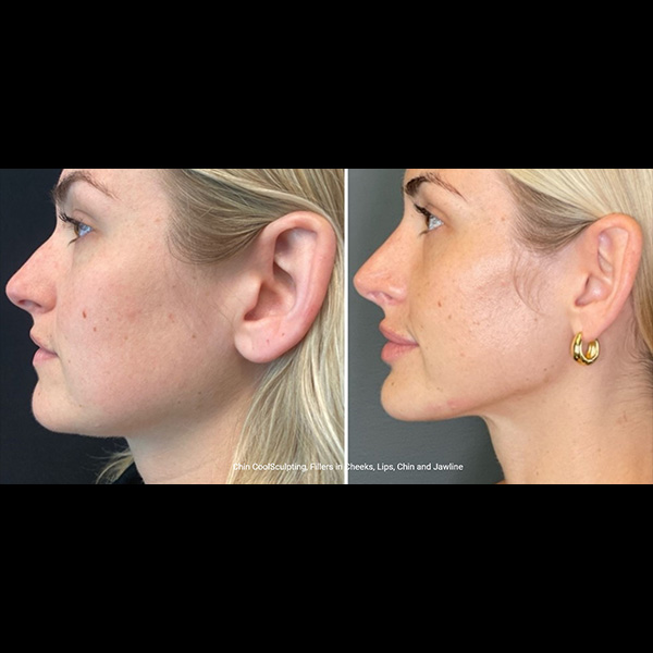 Chin-CoolSculpting-and-Fillers