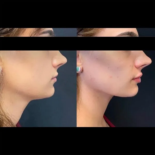 Chin-Filler Dermal fillers Scottsdale profile transformation with defined jawline and contoured chin.