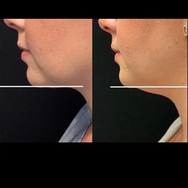 Chin-for-the-win Profile view of dermal fillers Scottsdale before and after showing reduced double chin and improved jawline.