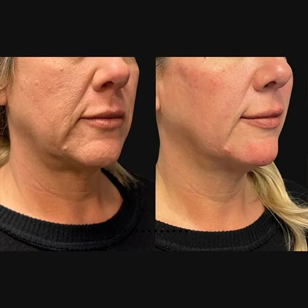 Dermal-Fillerb Dermal fillers Scottsdale before and after showing improved jawline definition and reduced wrinkles.