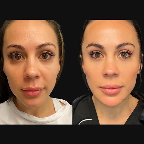 Filler-Face- Dermal fillers Scottsdale results with enhanced cheekbones and balanced facial proportions.