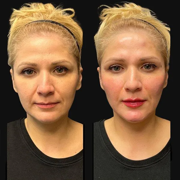 Filler Dermal fillers Scottsdale before and after showing restored lip volume and youthful contour.