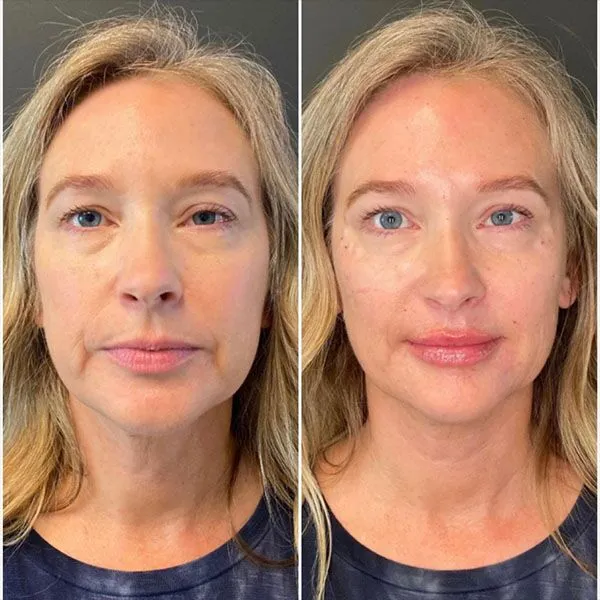 Full-Face- Full face dermal fillers Scottsdale results with plumper cheeks and rejuvenated facial appearance.