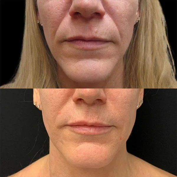 Full-Face-Filler