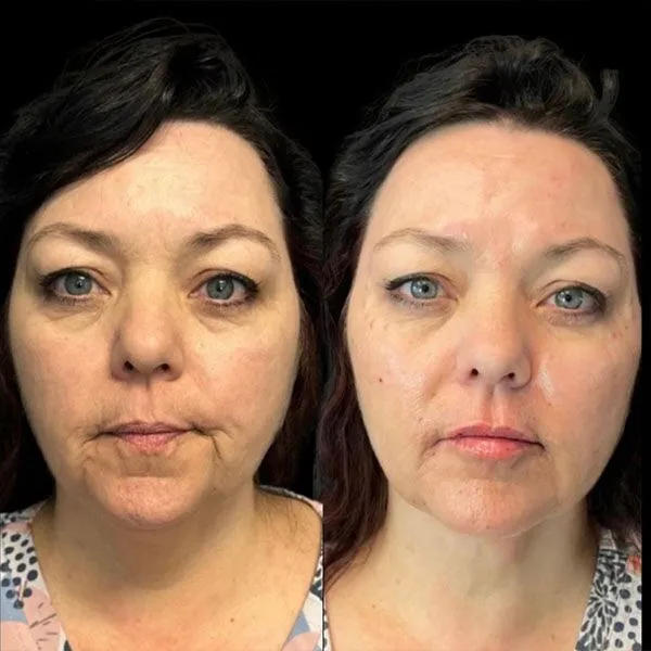 Full-Face-using-Juvederm-Fillers Dermal fillers Scottsdale before and after showing smoother skin texture and reduced acne scarring.