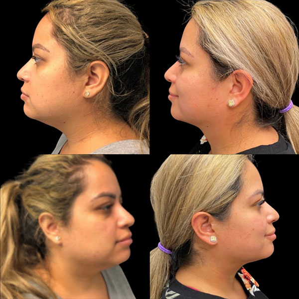 Kybella-before-and-after