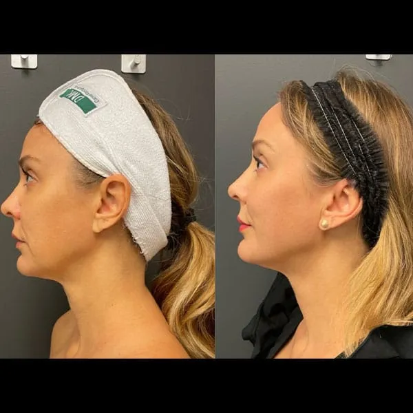 RF-Microneedling-1-2