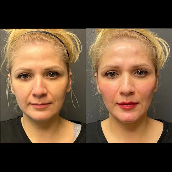 Voluma-Immediate-post-treatment-Cheeks-Chin-and-Lips