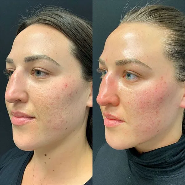 cheeks-and-chin Dermal fillers Scottsdale before and after showing smoother skin texture and reduced acne scarring.