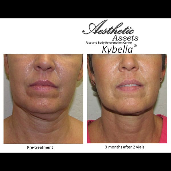 kybella-1