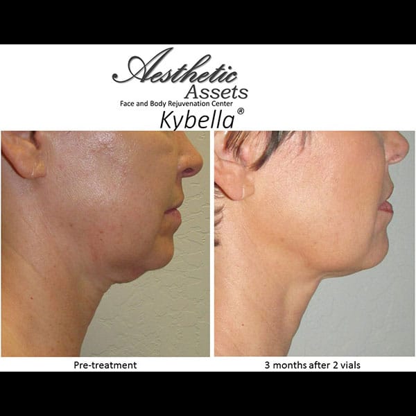 kybella-2
