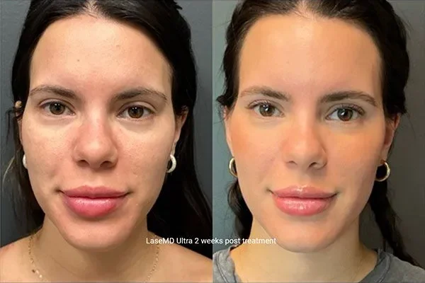 laseMD-ultra-3 laseMD-ultra-3