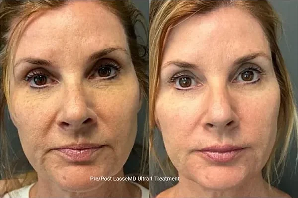 laseMD-ultra-x1-1 laseMD-ultra-x1-1