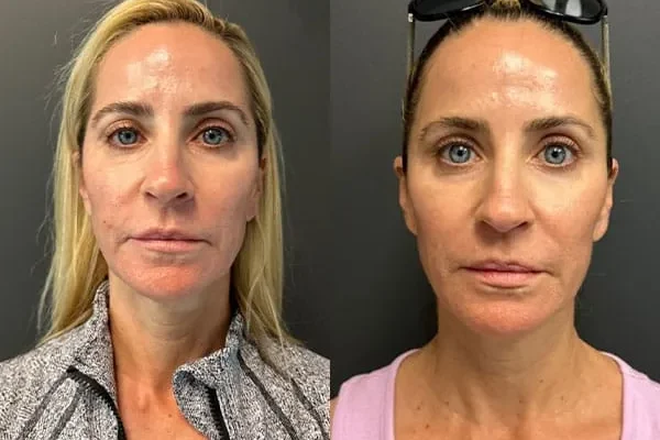 prf-ez-gel-lasemd-1 prf-ez-gel-lasemd-1