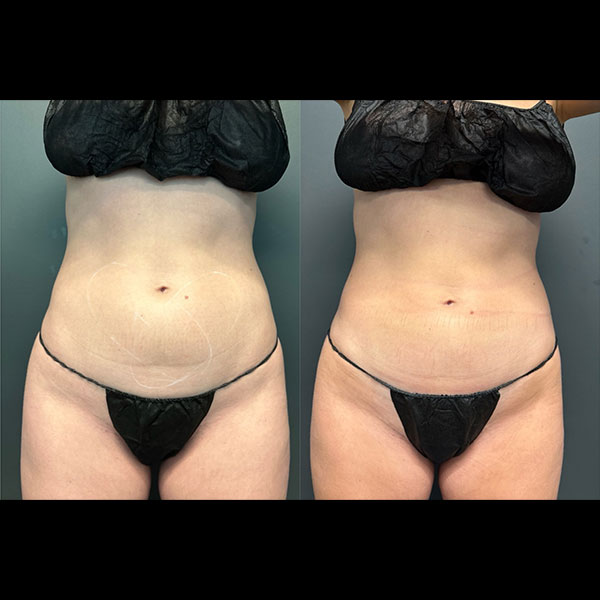 Body-Contouring-12-1