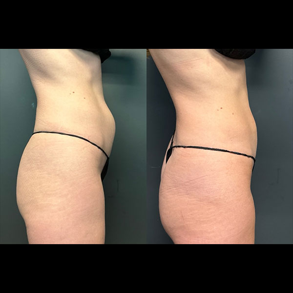 Body-Contouring-12-2